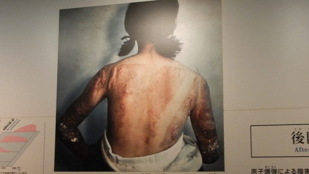 Survivors of the atomic bombing continued to suffer long after the event. Many people developed Keloids, which are growths that appears on the faces, necks, backs and joints that caused tremendous physical and emotional pain to their victims.