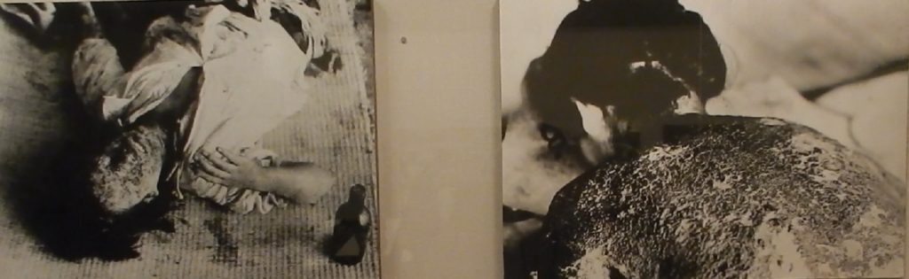 Pictures of horrific burn victims in the bombing